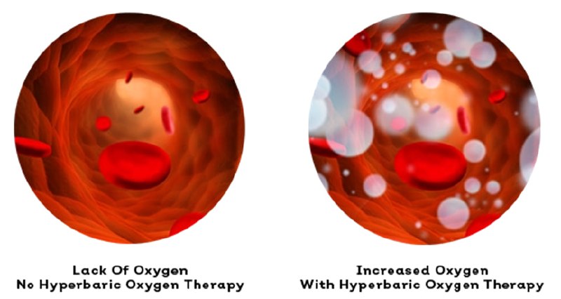Comparison: Lack of Oxygen without HBOT vs Increased Oxygen with Hyperbaric Oxygen Therapy